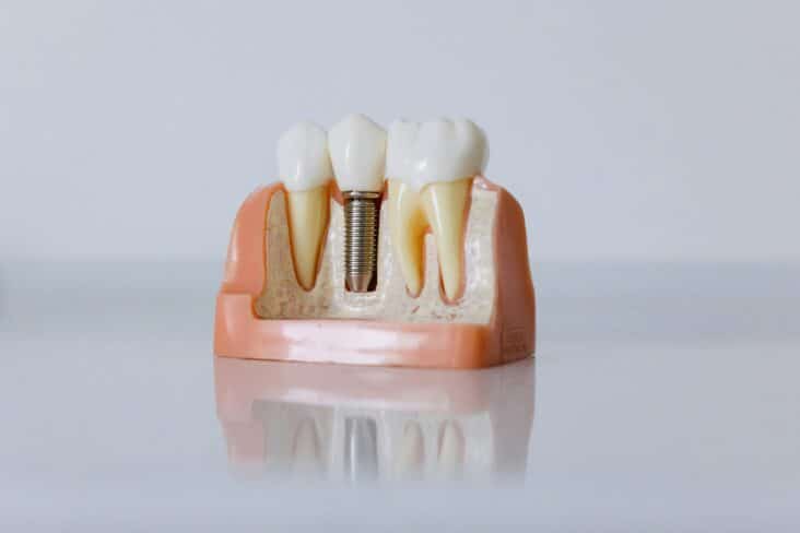 Implantes dentales