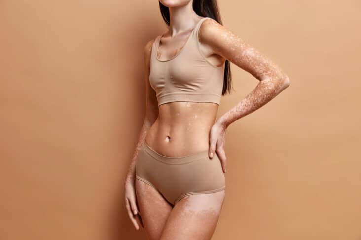 vitiligo